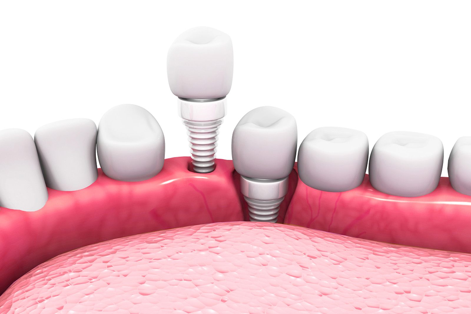 Dental implants 3D illustration