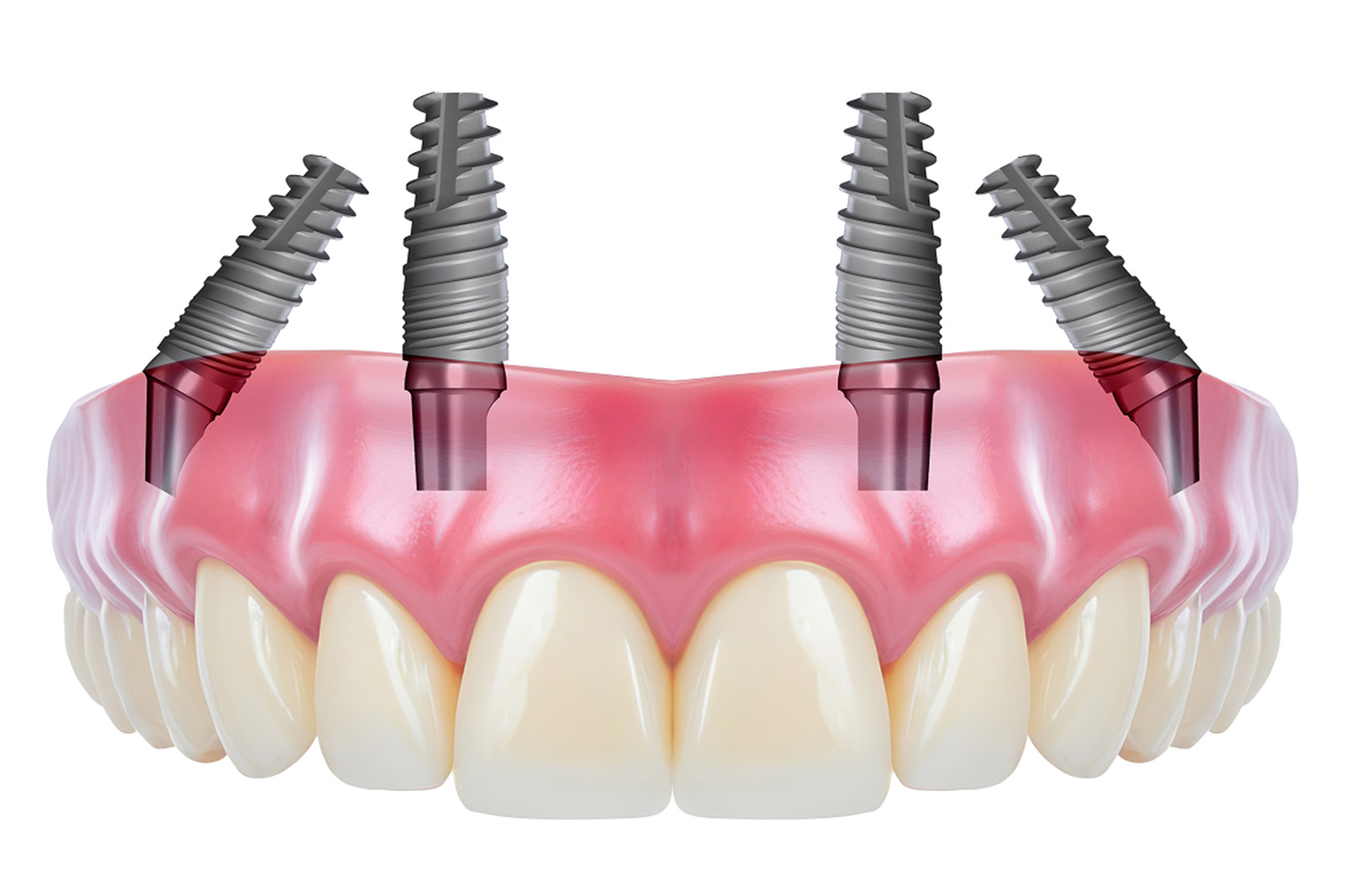 New teeth in one day 3D illustration