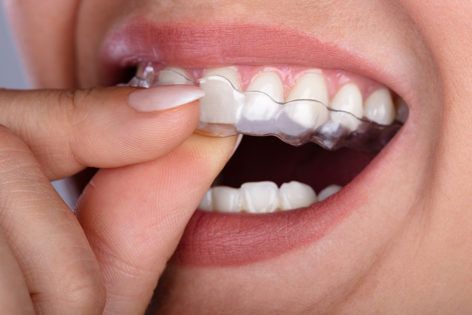 A woman putting on a transparent aligner onto her teeth